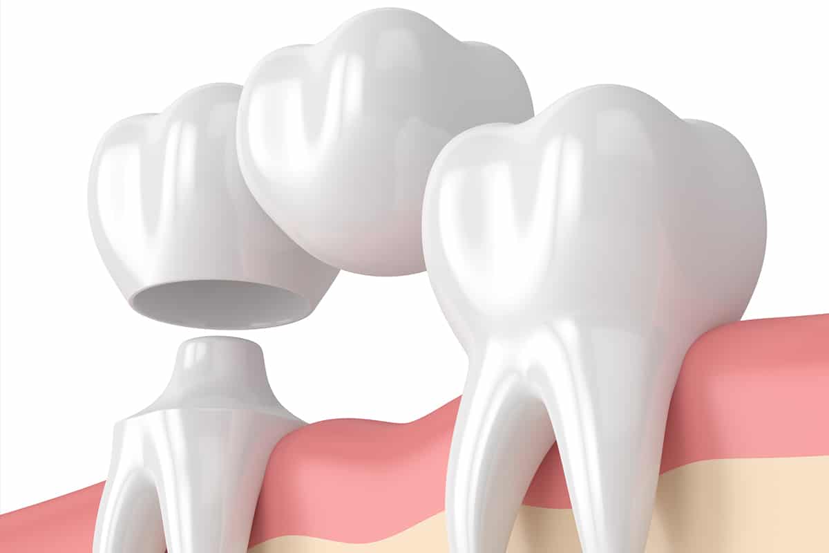 Bridges vs implants which is the best solution for missing teeth blog