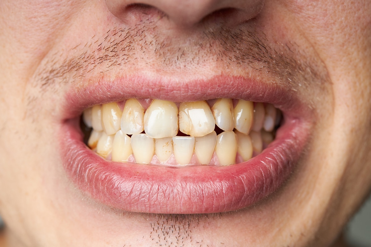 What you need to know about dental fillings composite vs amalgam blog